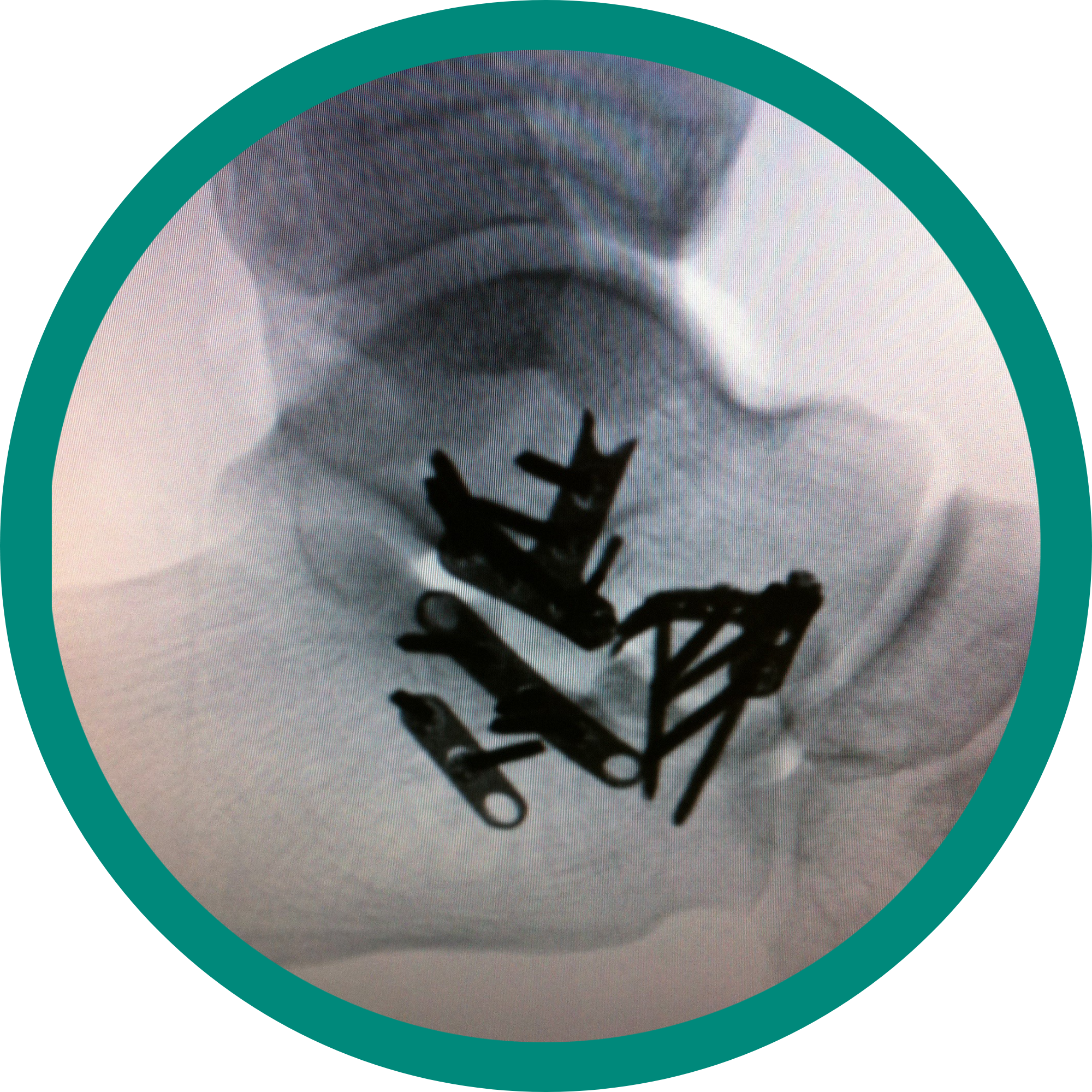 Xray visual of an orthopedic reconstruction surgery