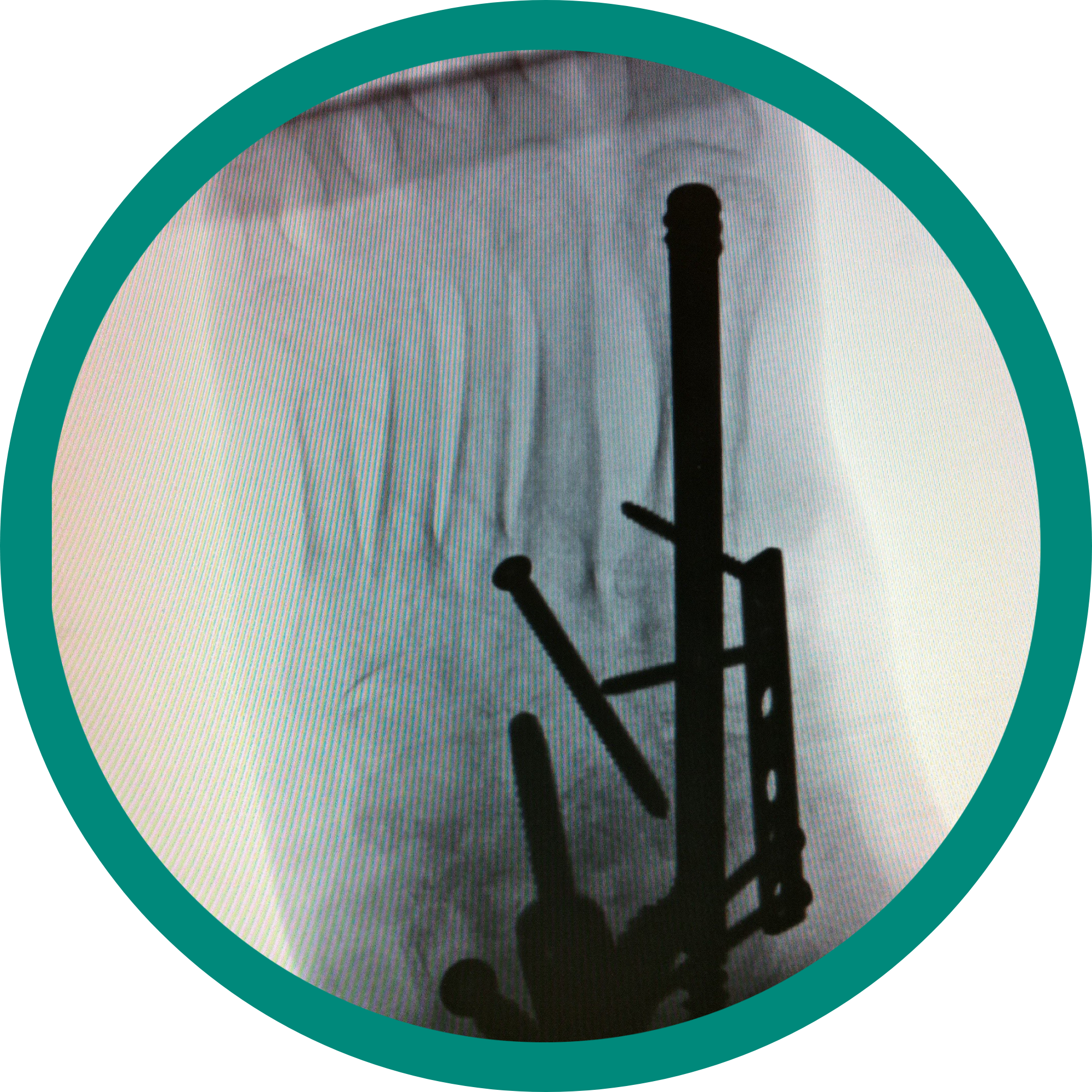 Xray visual of an orthopedic reconstruction surgery
