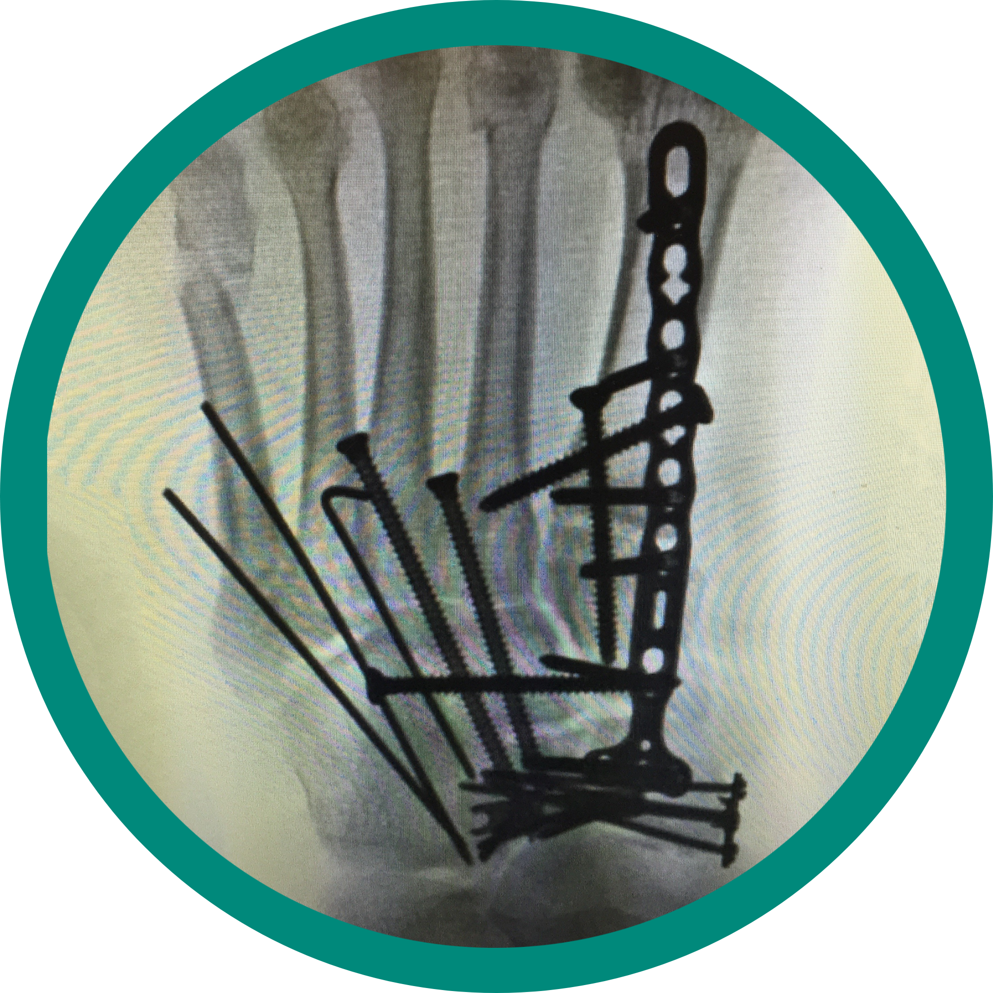 Xray visual of an orthopedic reconstruction surgery