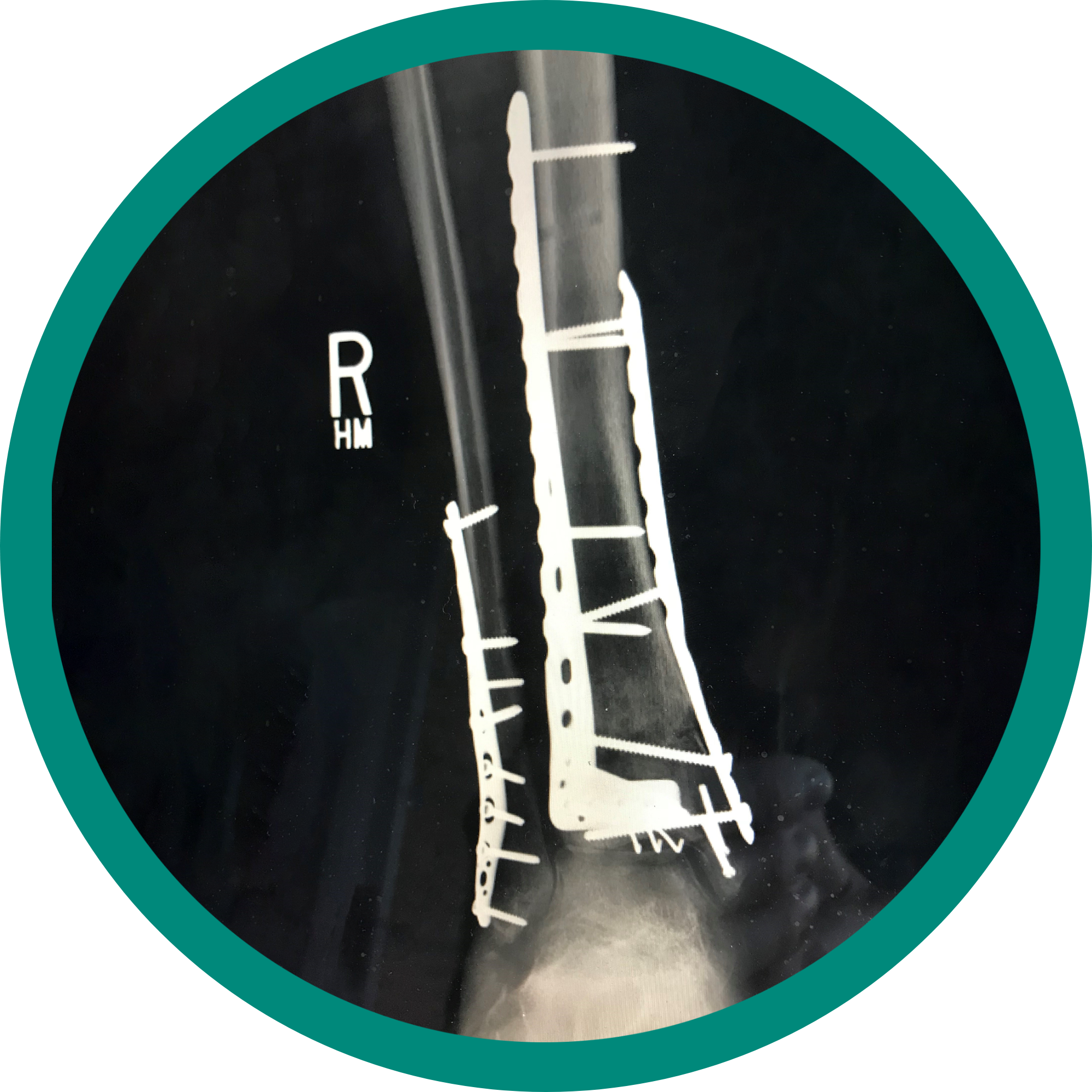 Xray visual of an orthopedic reconstruction surgery