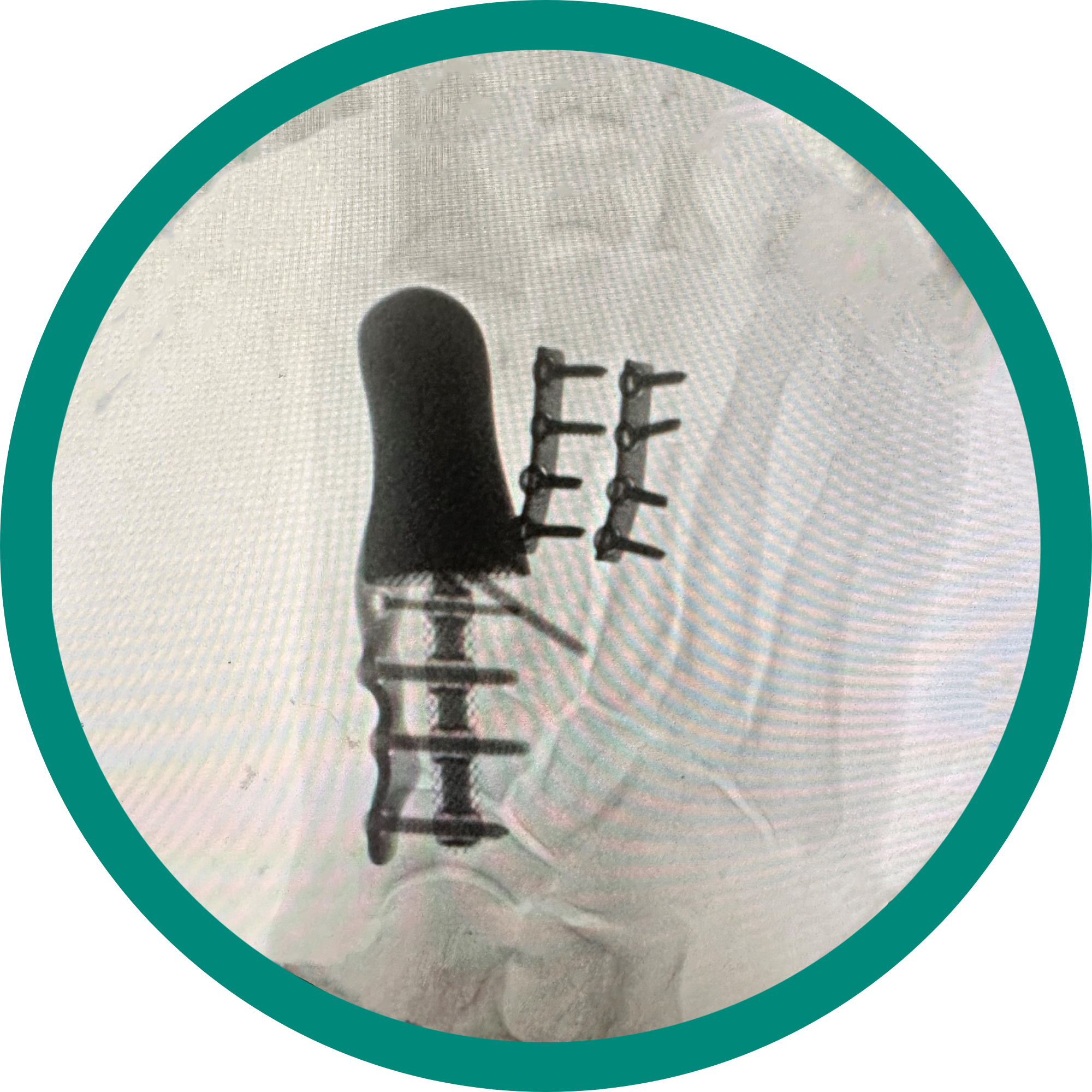 Xray visual of an orthopedic reconstruction surgery