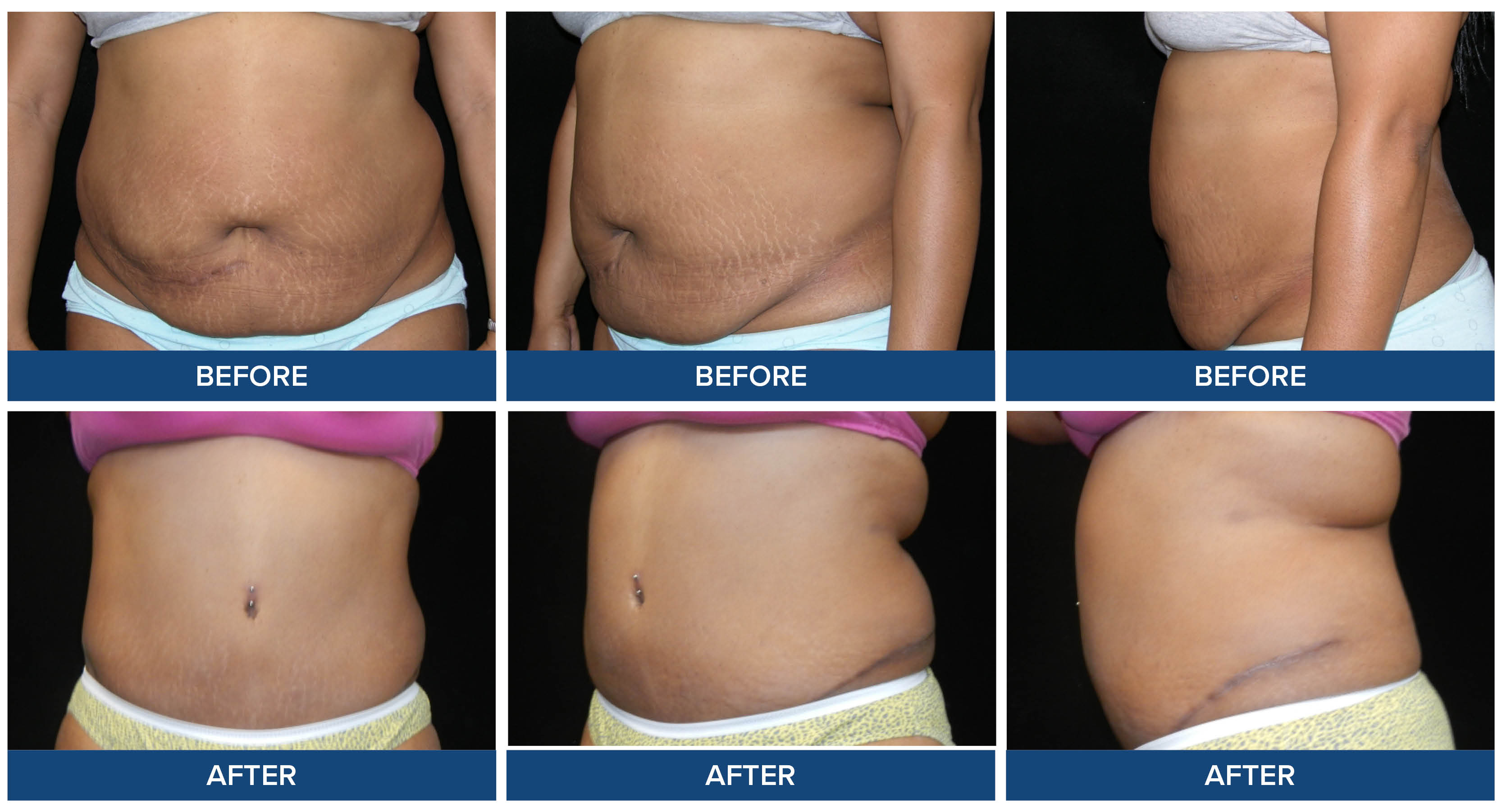 Abdominoplasty before and after photos by Dr. Raj Sinha