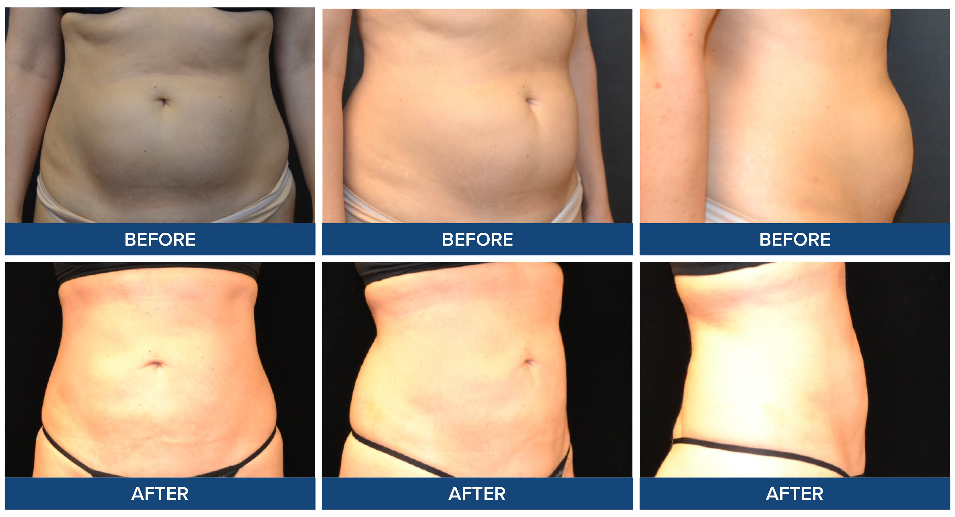 Abdomen liposuction before and after photos by Dr. Raj Sinha