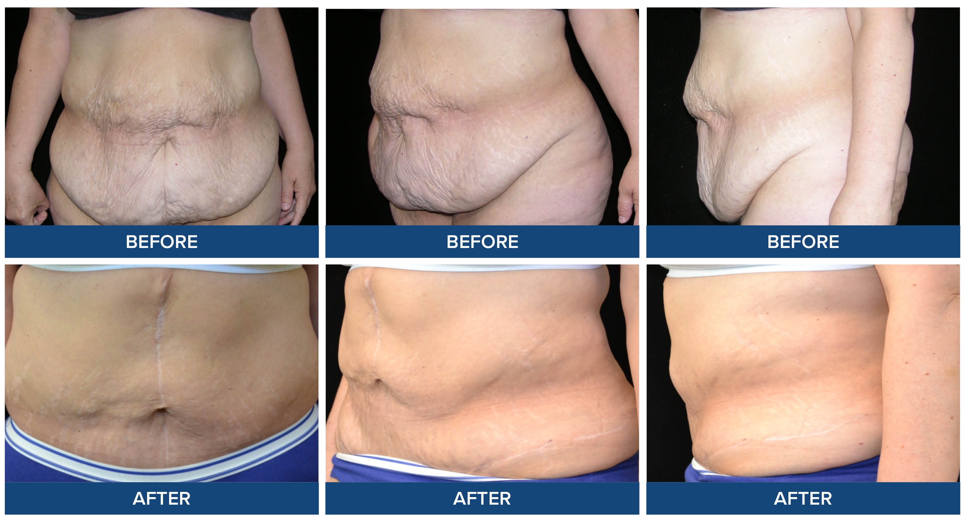 Abdominoplasty before and after photos by Dr. Raj Sinha