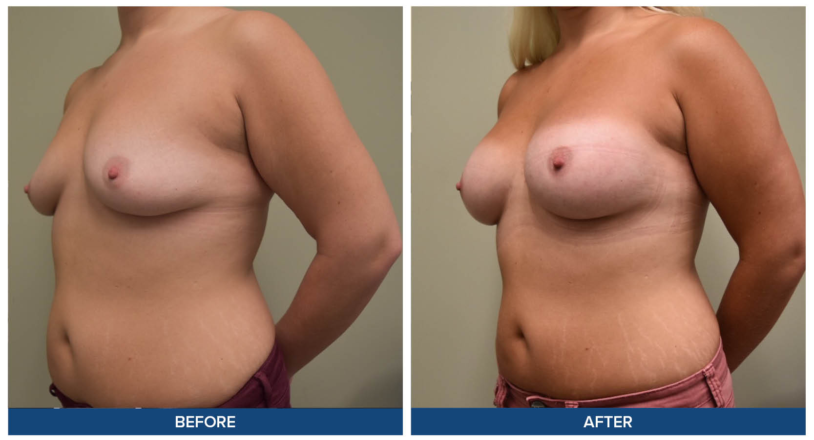 Breast augmentation before and after photos by Dr. Babis Rammos