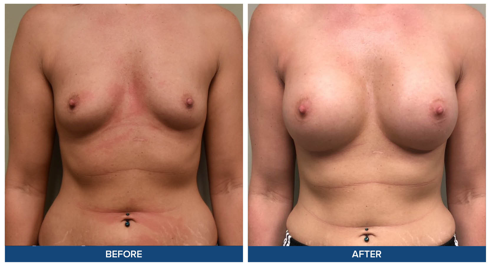 Breast augmentation before and after photos by Dr. Babis Rammos
