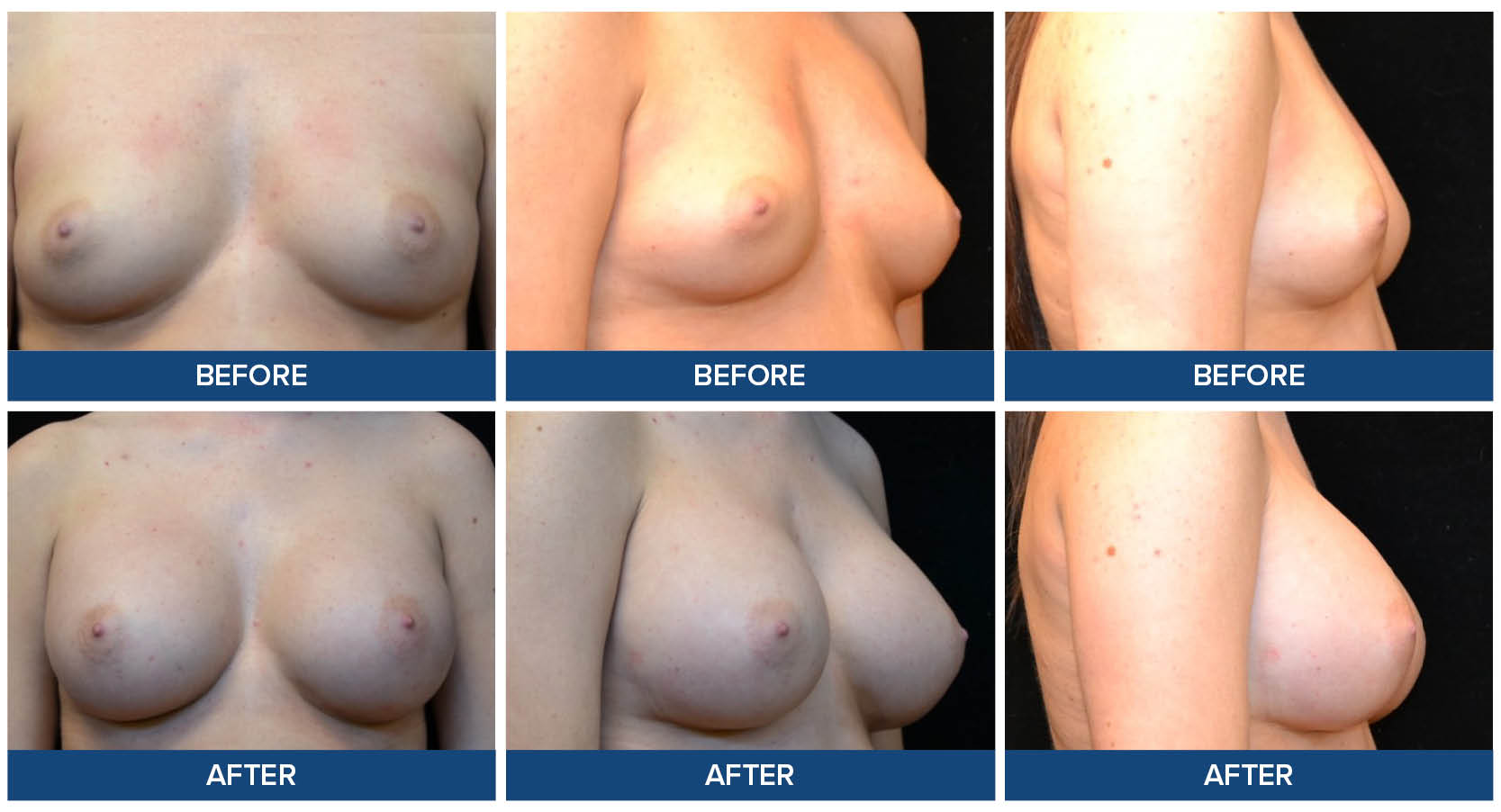 Breast augmentation before and after photos by Dr. Raj Sinha