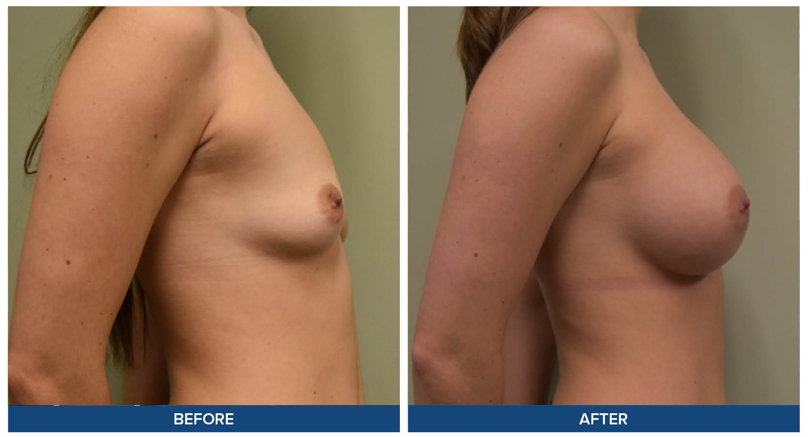 Breast augmentation before and after photos by Dr. Babis Rammos