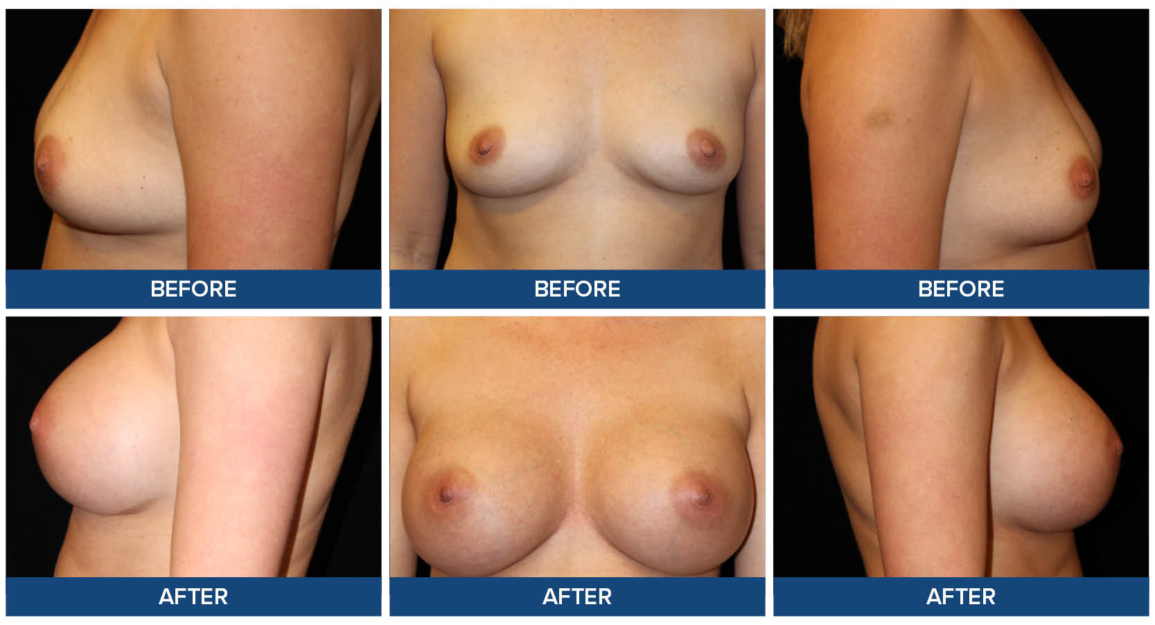 Breast augmentation before and after photos by Dr. Joel Wietfeldt