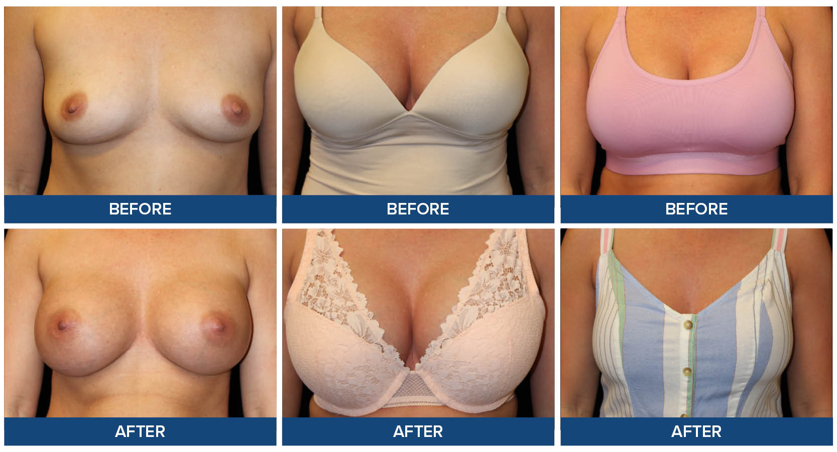 Breast augmentation before and after photos by Dr. Joel Wietfeldt