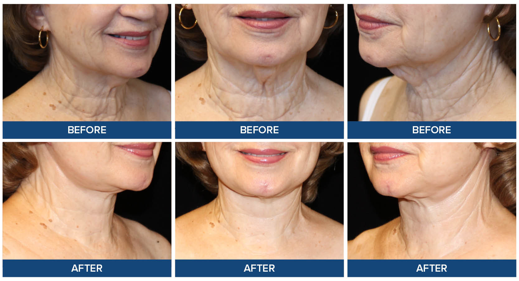 Neck lift before and after photos by Dr. Joel Wietfeldt