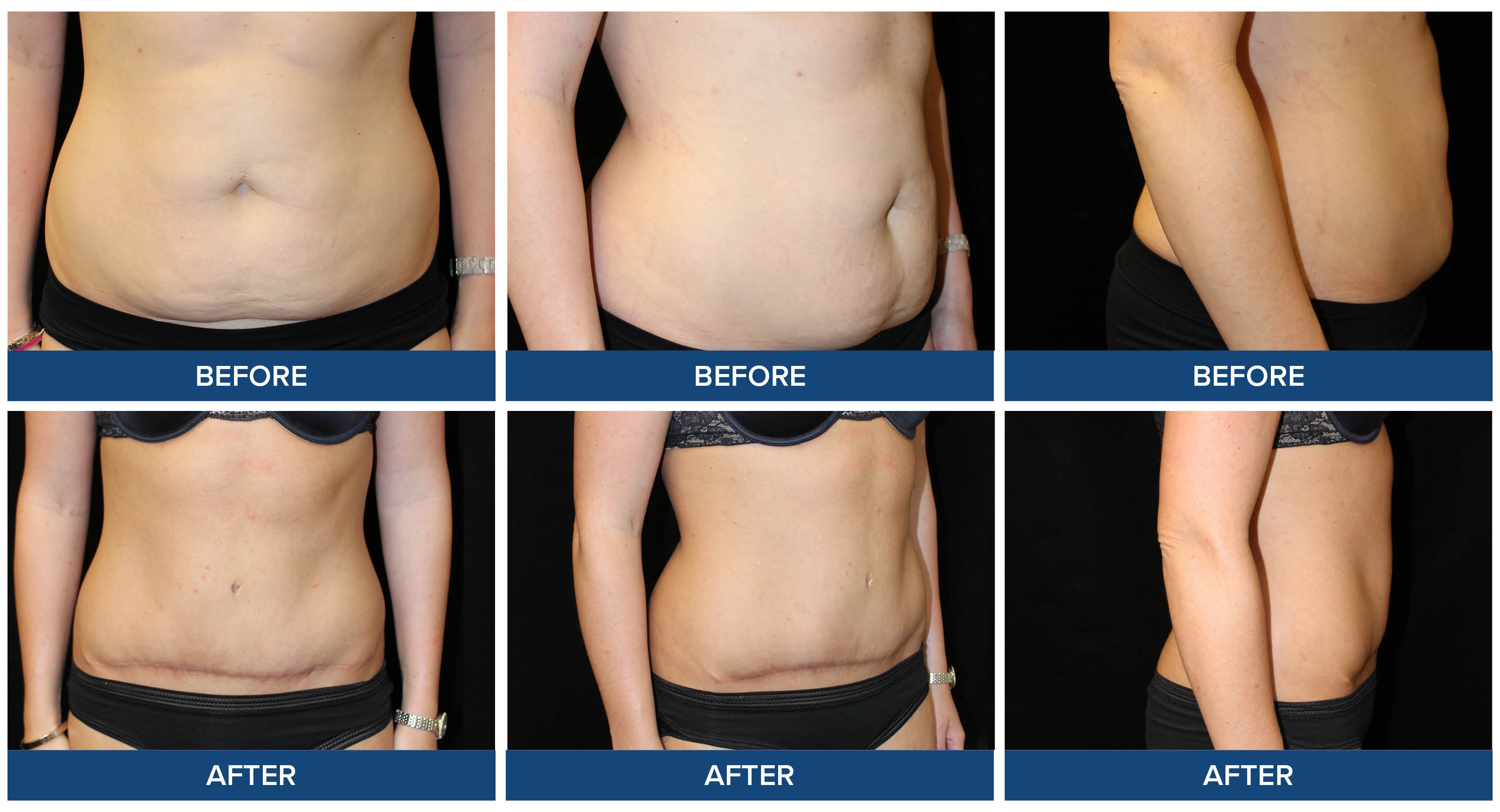 Abdominoplasty before and after photos by Dr. Joel Wietfeldt