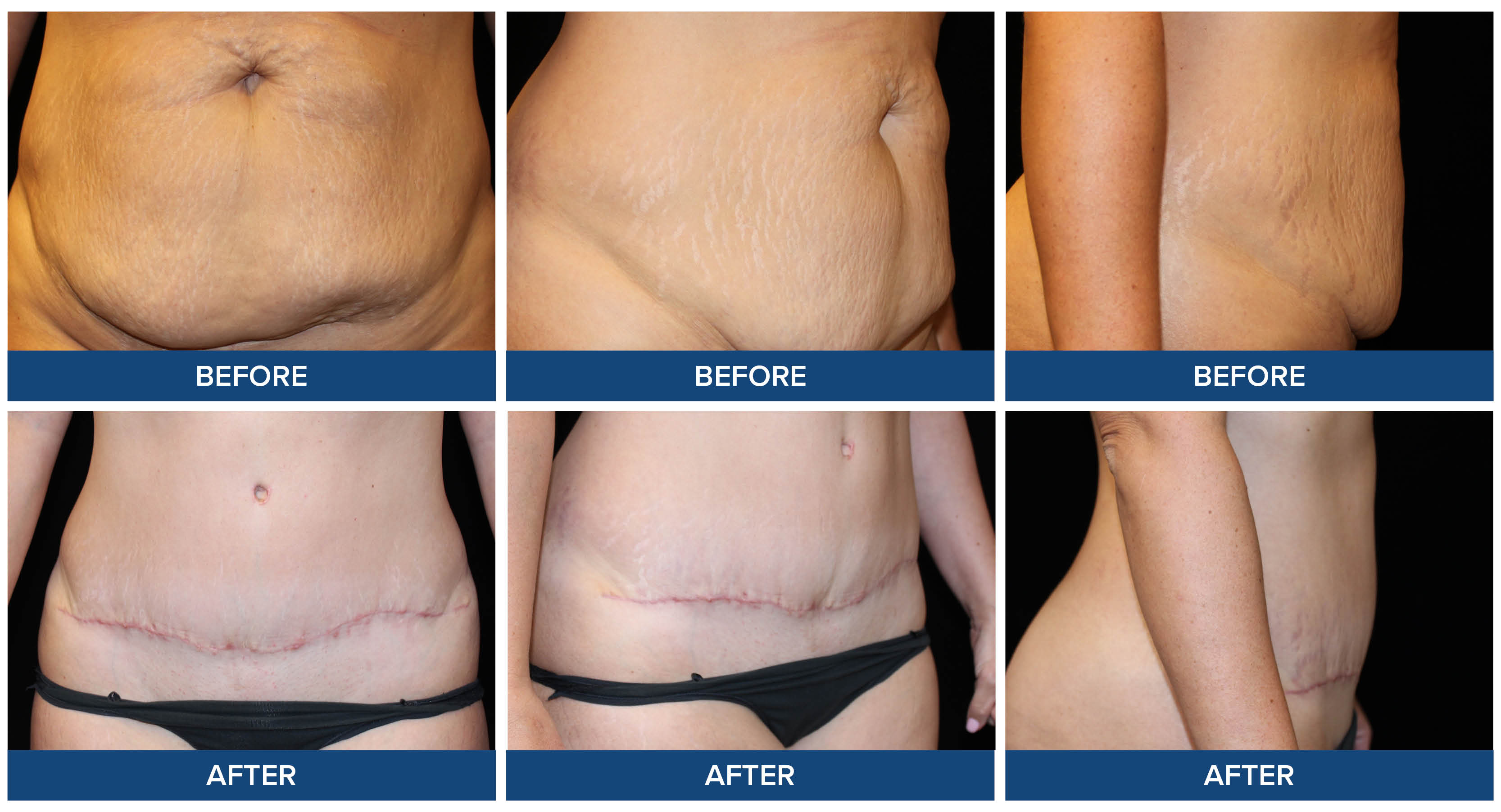 Abdominoplasty before and after photos by Dr. Joel Wietfeldt