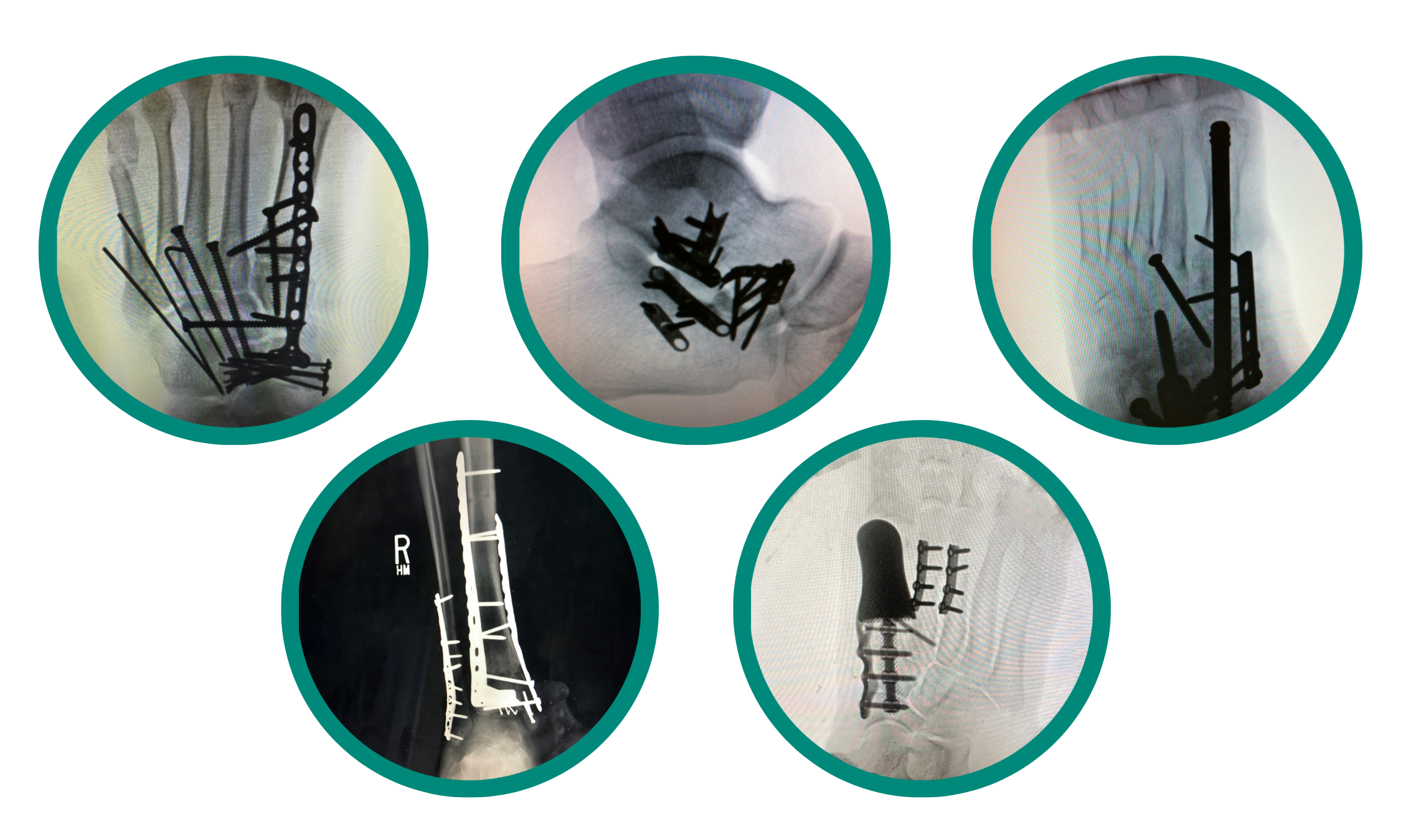 Images of foot and ankle reconstruction procedures