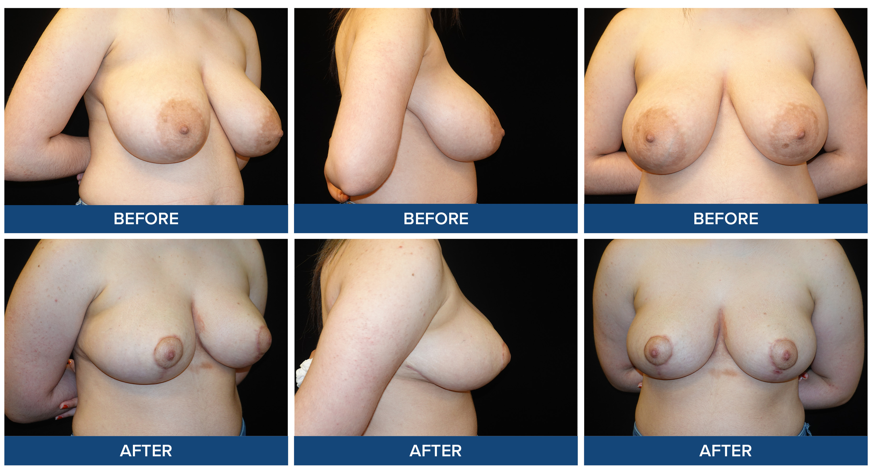 Before and after photos of a female patient bilateral breast reduction procedure.