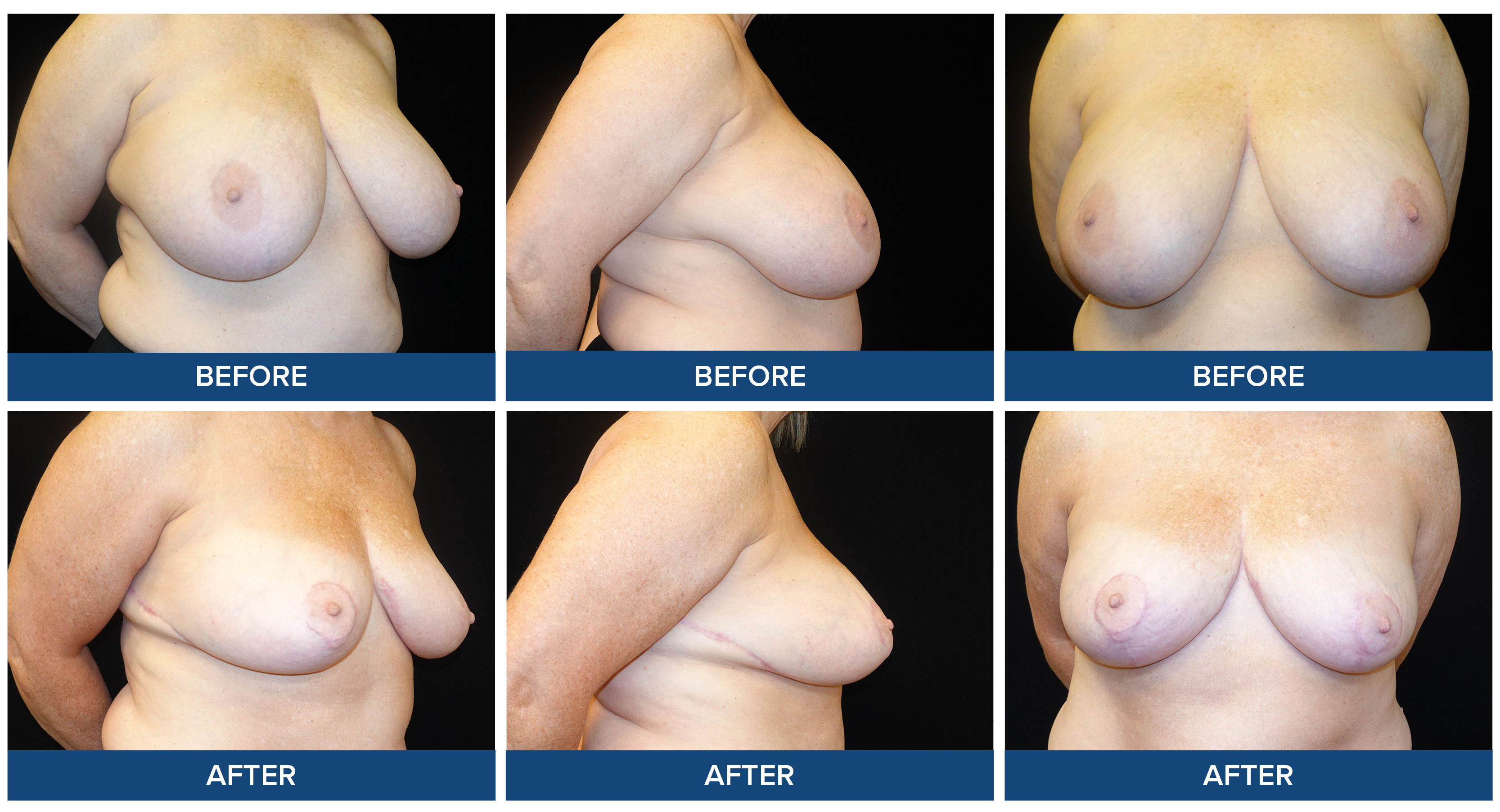 Before and after photos of a female patient bilateral breast reduction procedure.