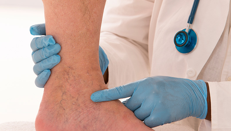 Medical professional with blue gloves pointing to veins on patient's foot