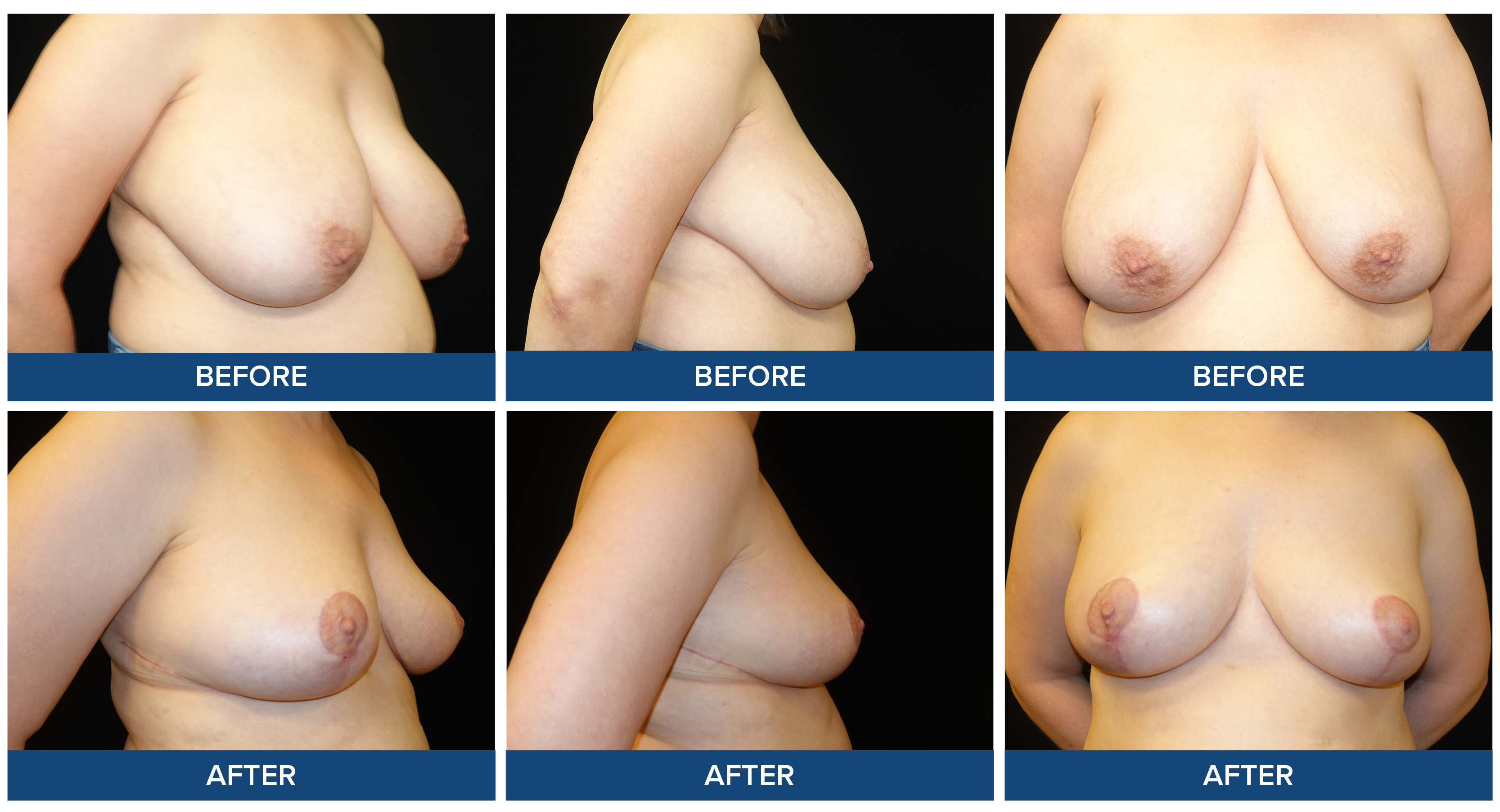 Before and after photos of a female patient breast reduction procedure.