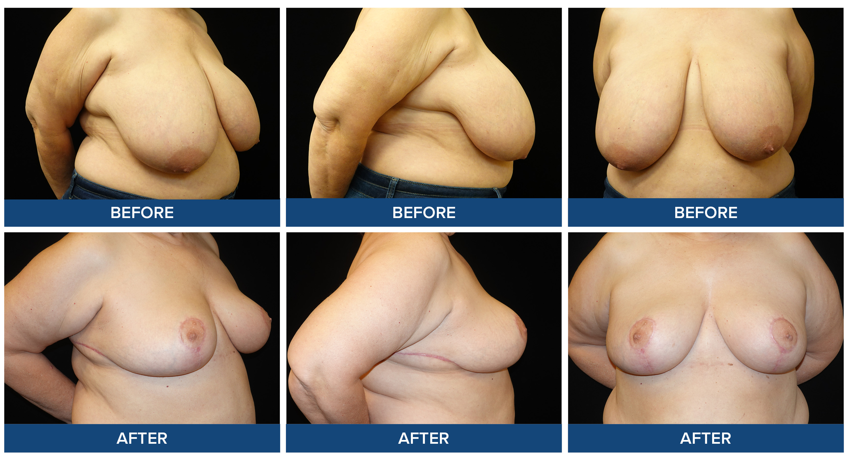 Before and after photos of a female patient breast reduction procedure.