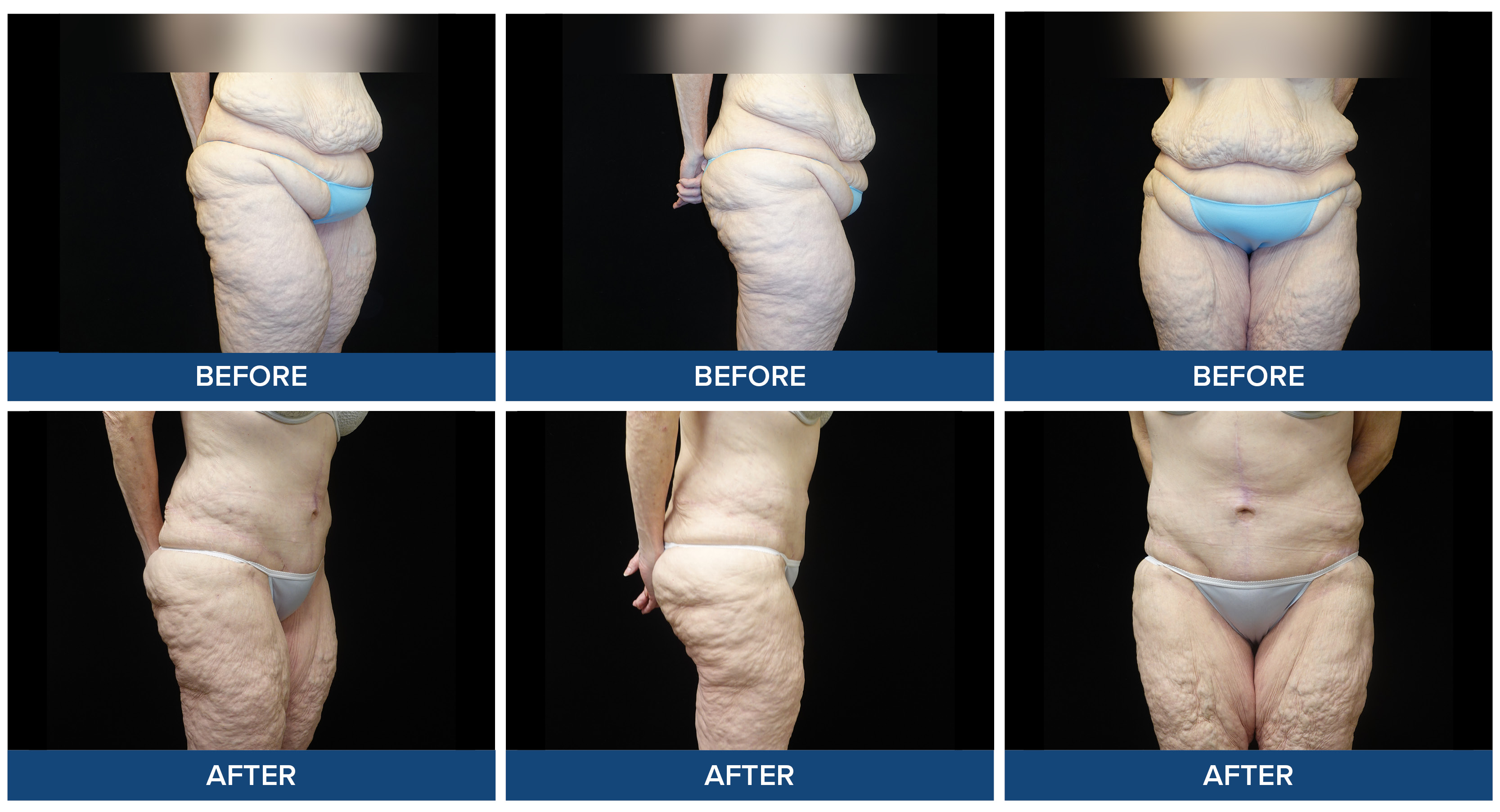 Female patient before and after photos of abdominoplasty panniculectomy procedure.
