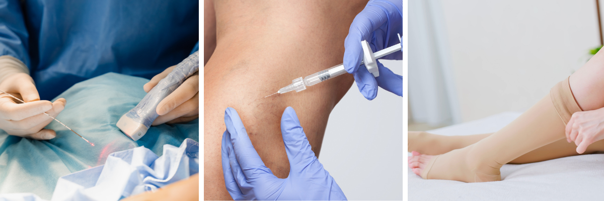 Treatment options for varicose veins