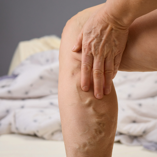 Closeup of varicose veins on leg