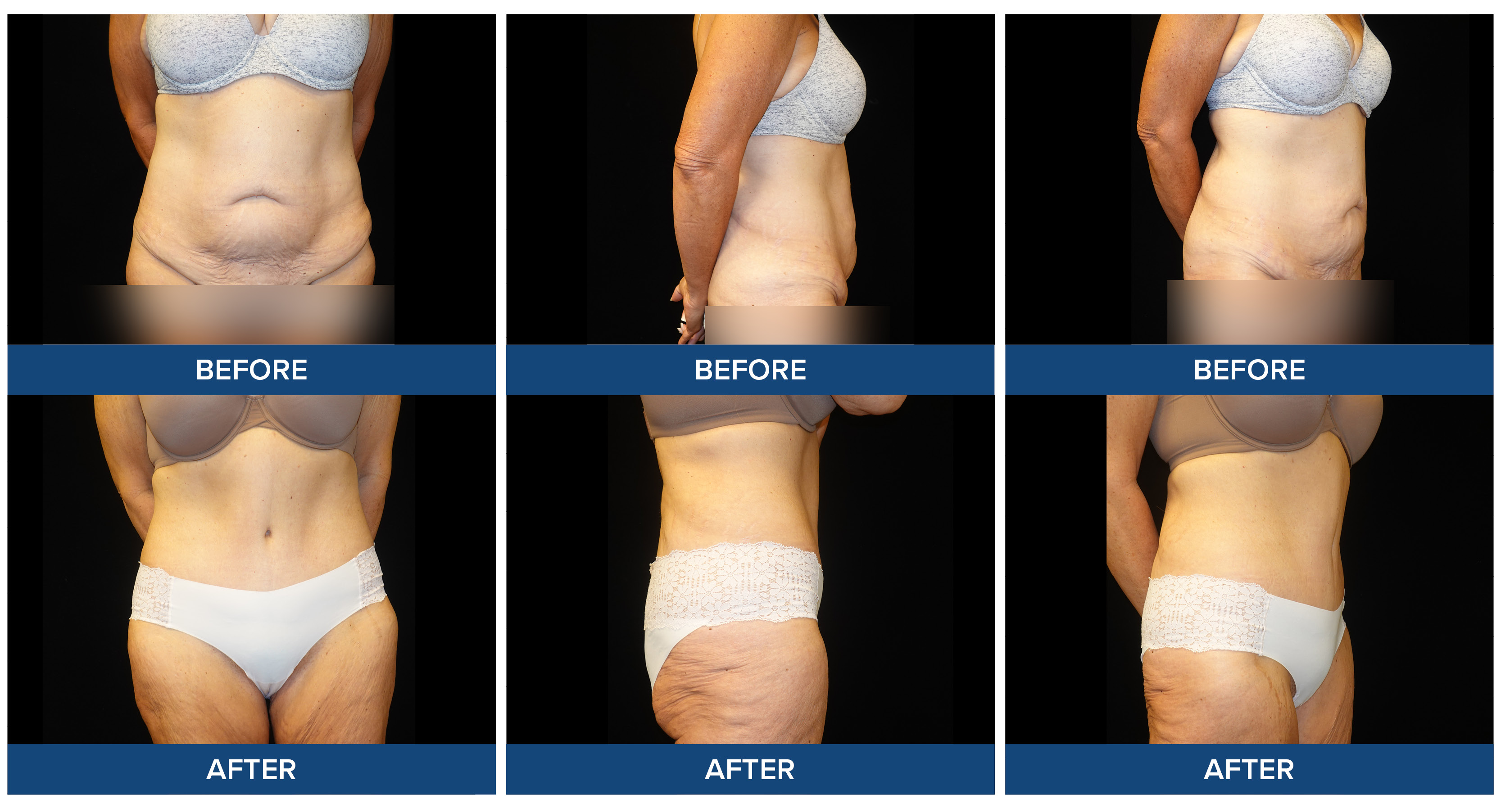 Female patient before and after photos of abdominoplasty procedure.