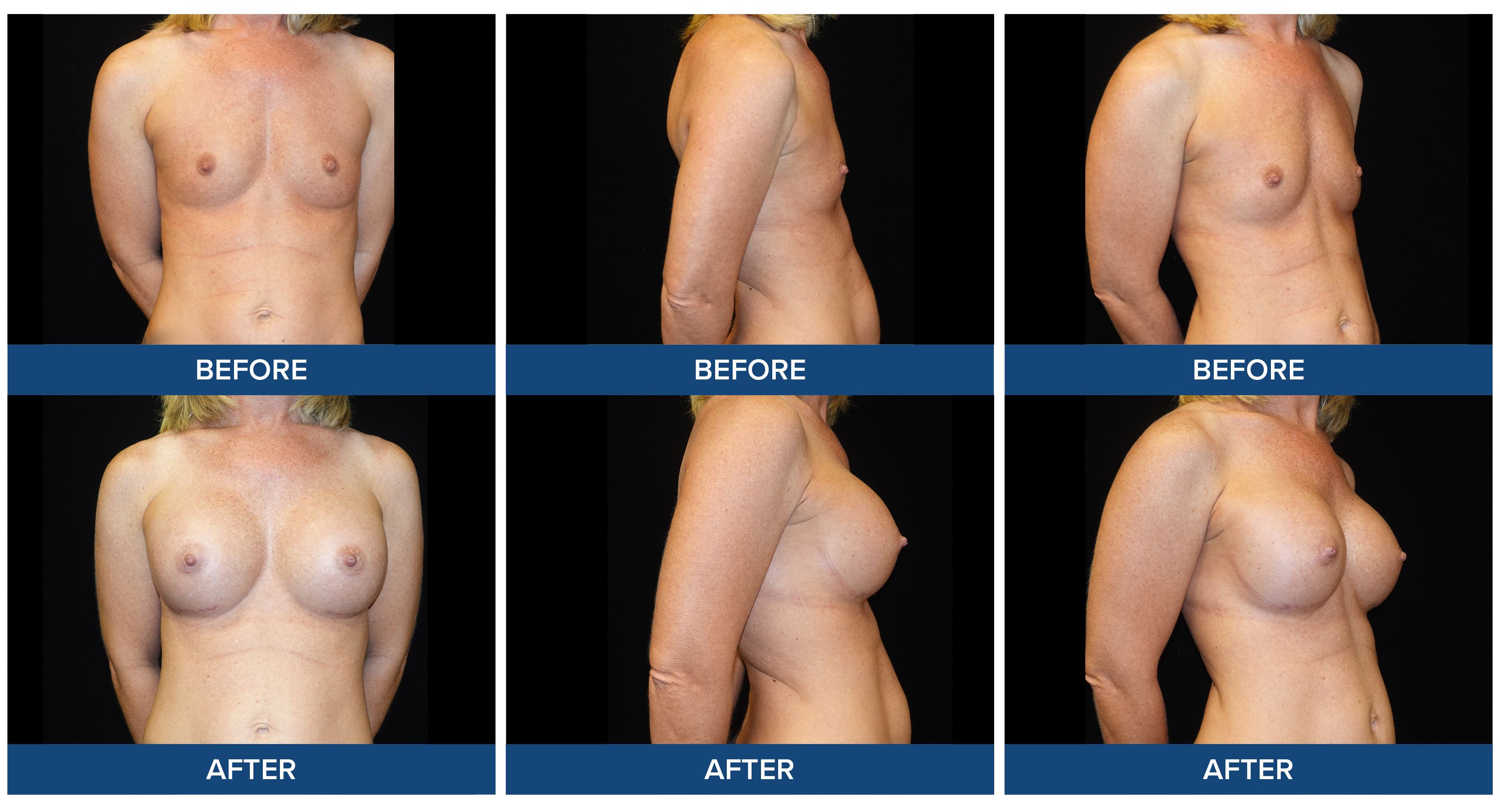 Female patient before and after photos of breast augmentation procedure.