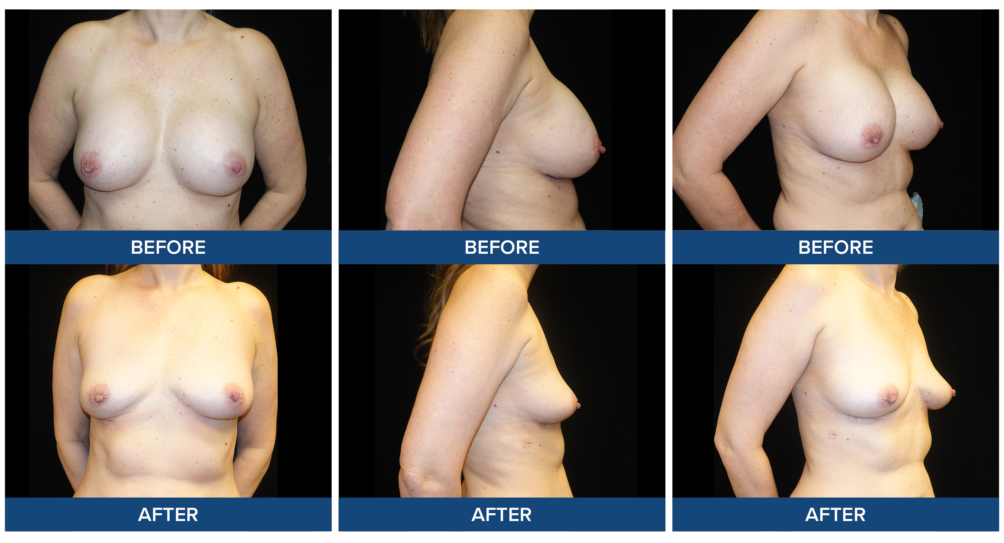 Female patient before and after photos of breast explant procedure.