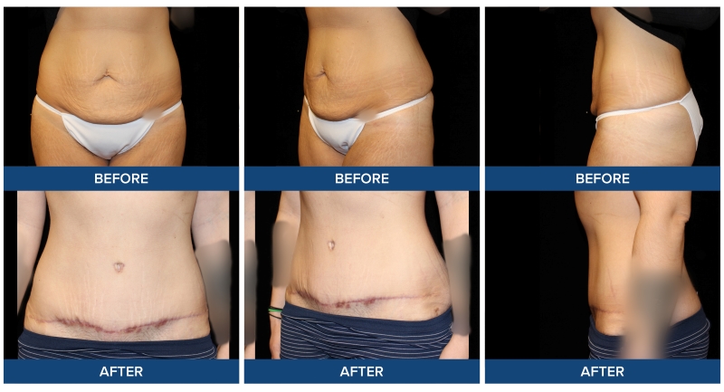 Before and after photos of an abdominoplasty with plication completed by Dr. Joel Wietfeldt.