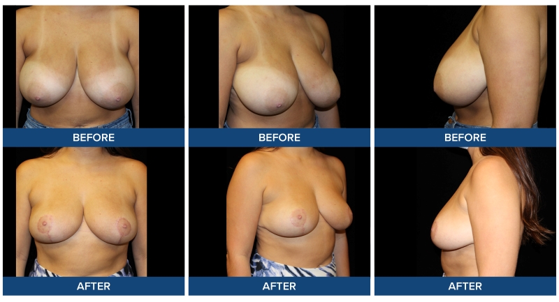 Before and after photos of a bilateral breast reduction completed by Dr. Joel Wietfeldt.