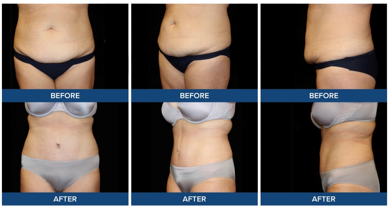 Before and after photos of an abdominoplasty with plication completed by Dr. Joel Wietfeldt.