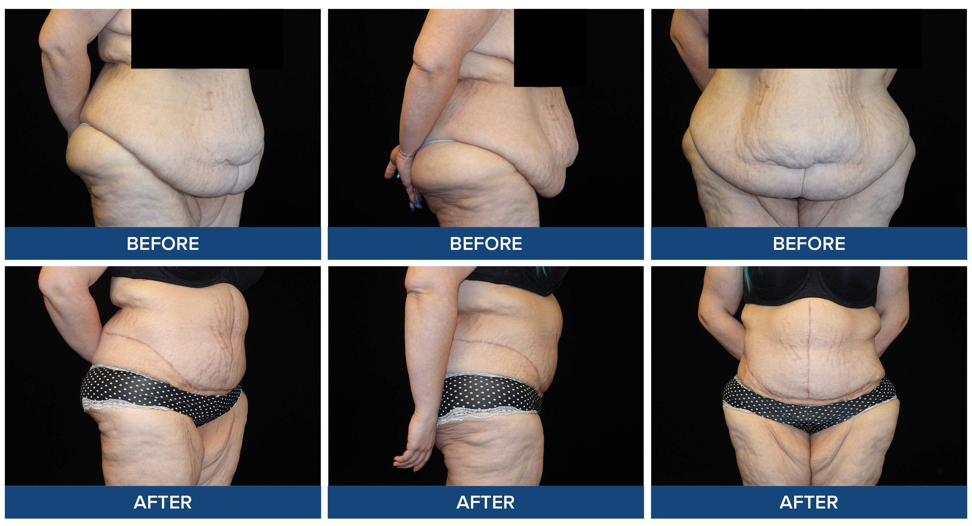 Before and after photos of a female abdominoplasty procedure.