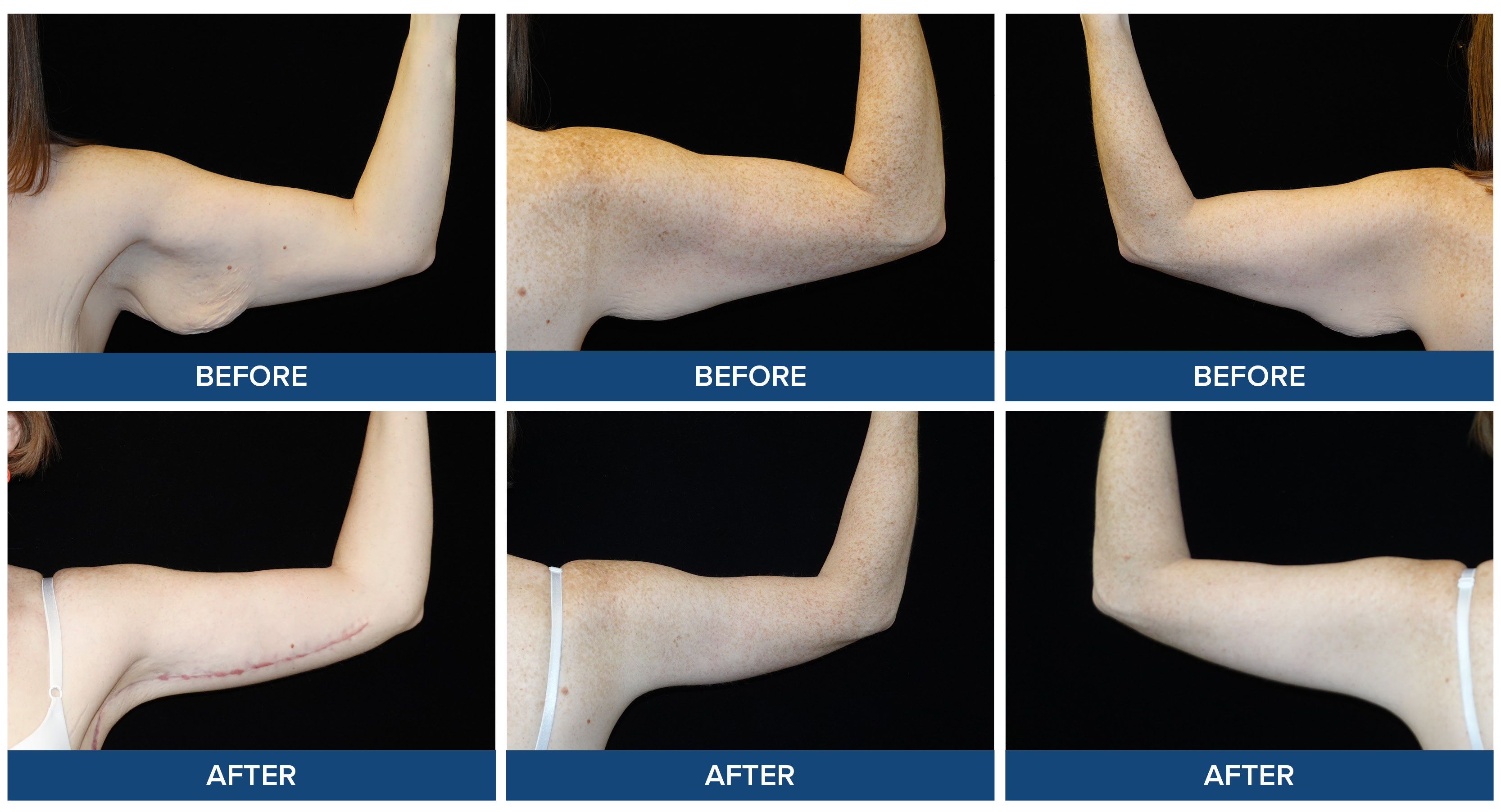 Before and after photos of brachioplasty procedure.