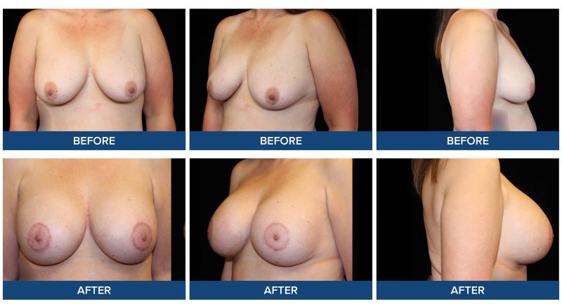 Before and after photos of a bilateral breast augmentation with donut mastopexy completed by Dr. Joel Wietfeldt.