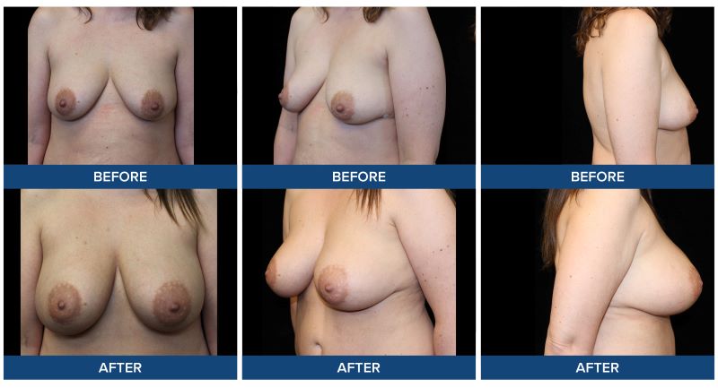 Before and after photos of a bilateral breast augmentation completed by Dr. Joel Wietfeldt.