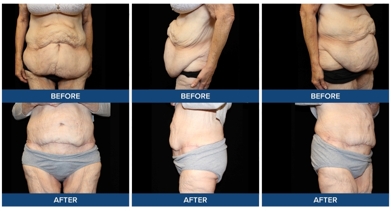 Before and after photos of a panniculectomy with abdominoplasty procedure completed by Dr. Joel Wietfeldt.