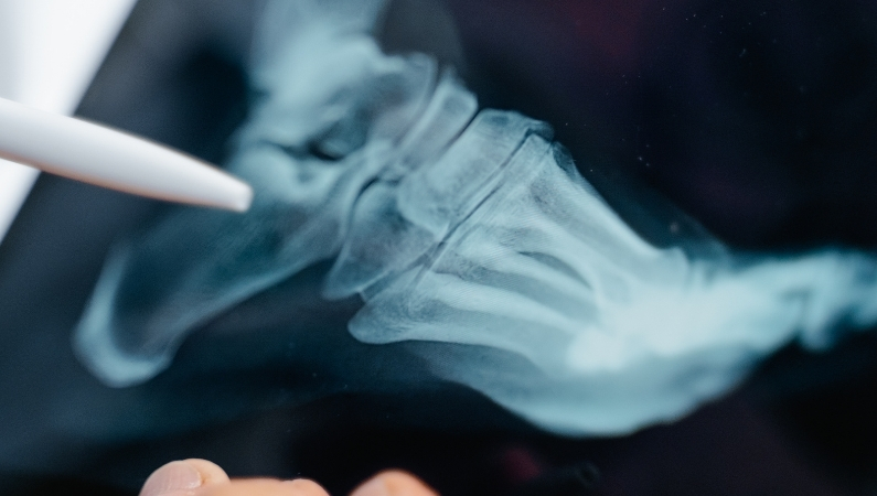Xray of foot