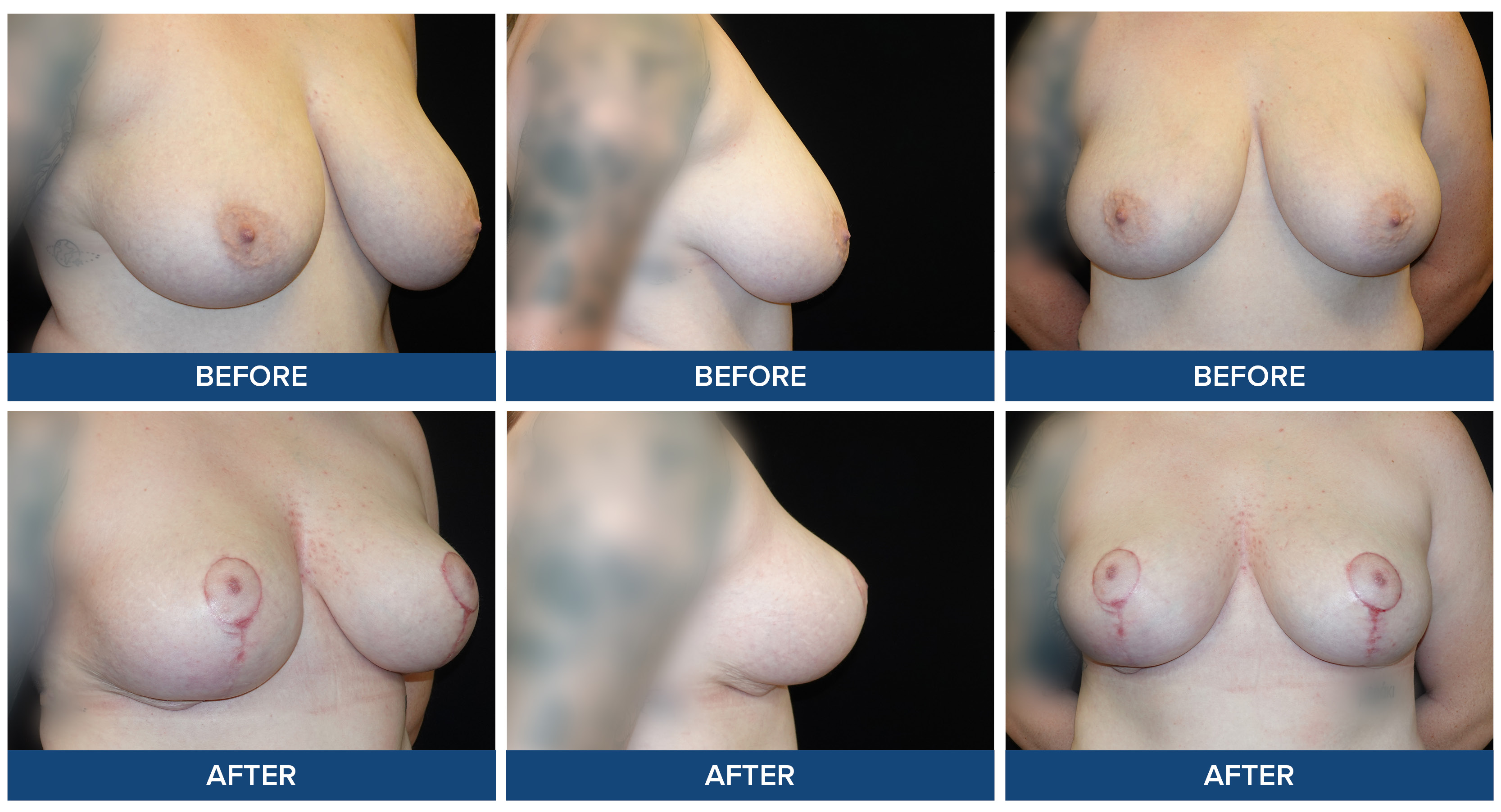 Before and after collage of female bilateral breast reduction surgery.